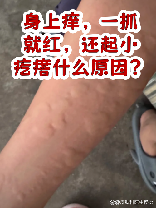 全身痒一挠就红一片然后就起疙瘩