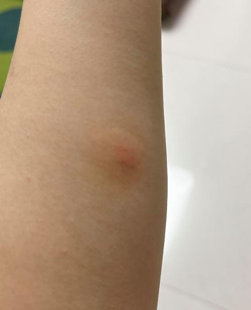被蜘蛛咬了的图片伤口是怎么样