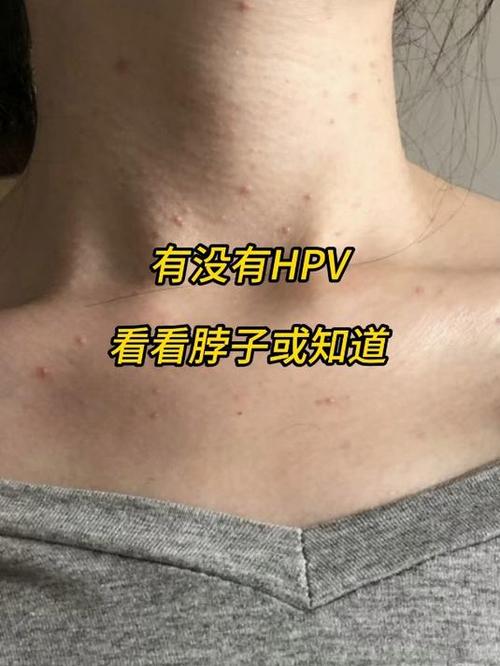 女性hpv最明显的征兆