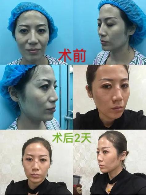 线雕断了会有感觉吗