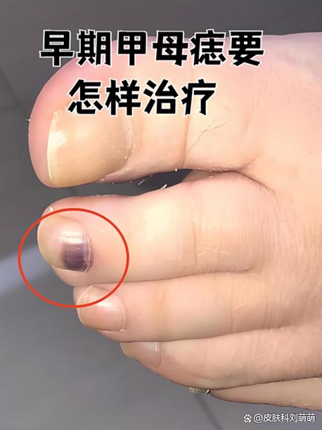 甲母痣一般长几个手指