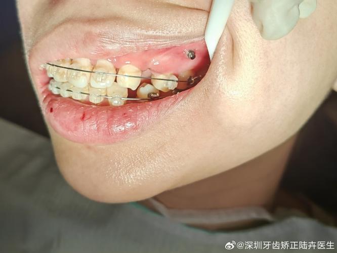骨钉要刷吗