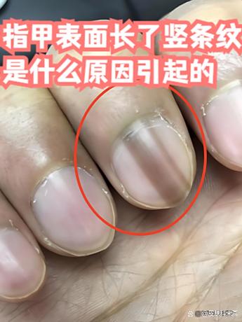 手指甲有竖纹怎么调理