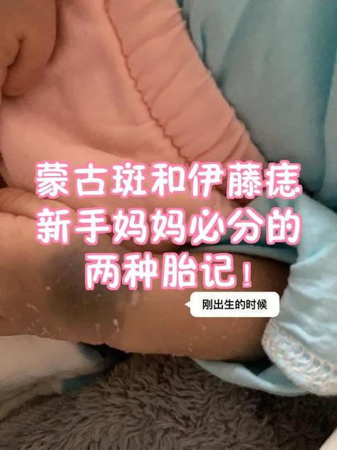 看胎记应该挂什么科