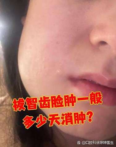 坏牙脸肿了一般几天恢复正常