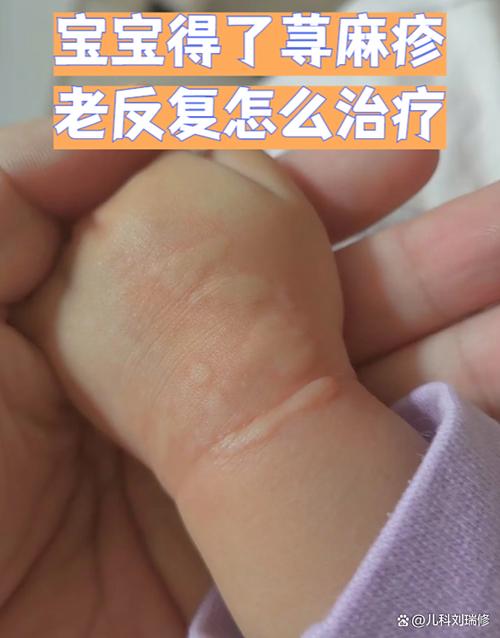过敏的治疗方法