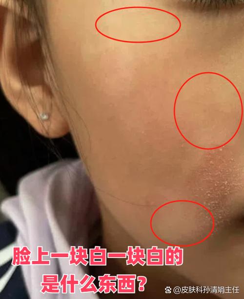 脸上花一块白一块怎么回事