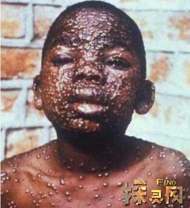 埃博拉病毒真实案例截图