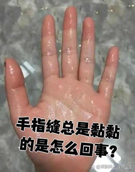 手指缝出汗发粘