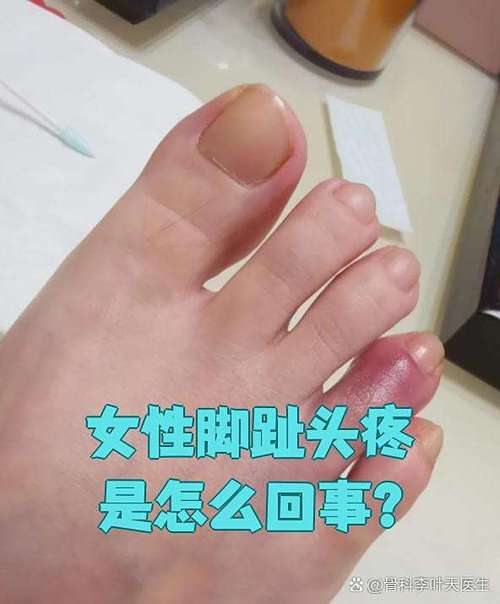 单独一个脚趾头疼