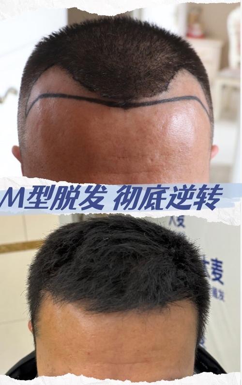 秃顶了还能长出头发吗