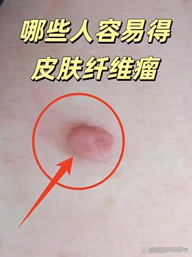 女性腿窝有疙瘩要警惕