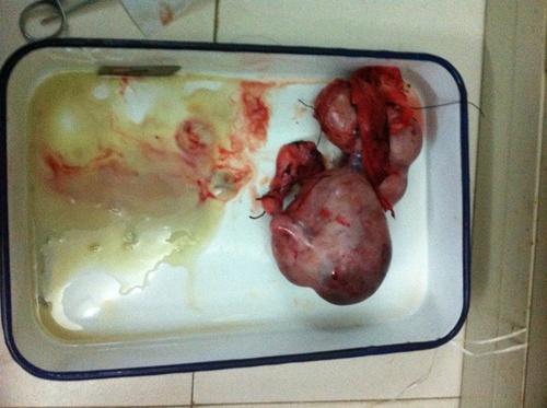 寄生液体寄生子宫