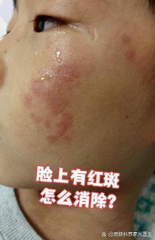 脸上红斑最快消除方法