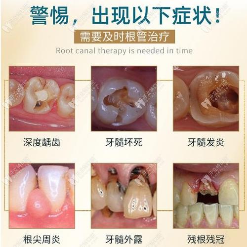 补牙贵还是根管治疗贵