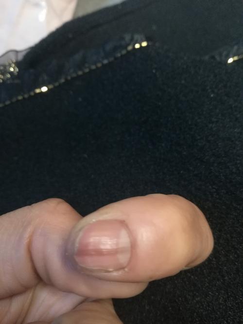 手指甲有黑色竖纹,是咋回事