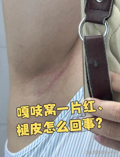 咯吱窝又痒又疼怎么回事截图