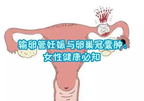 输卵管伞端粘连是什么原因造成的