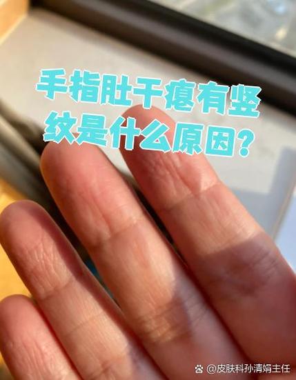 手指有竖纹截图