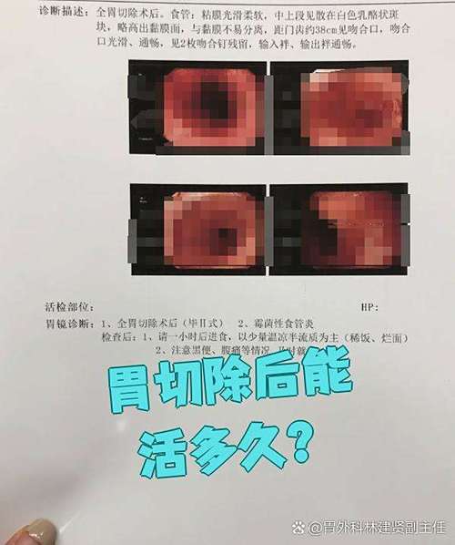 胃全切有活20年的吗