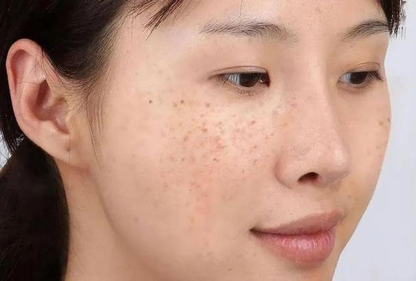 女人脸上有斑点是怎么造成的