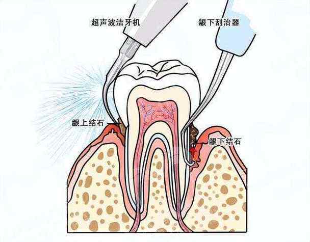 牙齿晃动了还有救吗