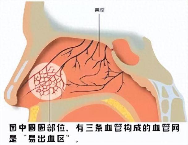 流鼻血是身体哪里出现问题截图