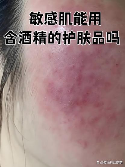 皮肤屏障受损长痘痘怎么治愈
