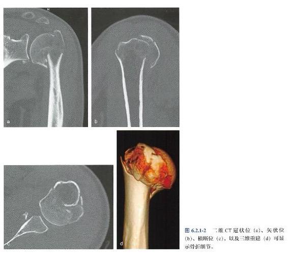 肱骨近端骨折多久才能恢复正常