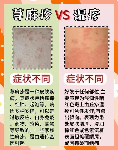 如何治疗荨麻疹不复发