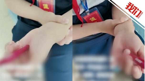 被圆珠笔戳伤