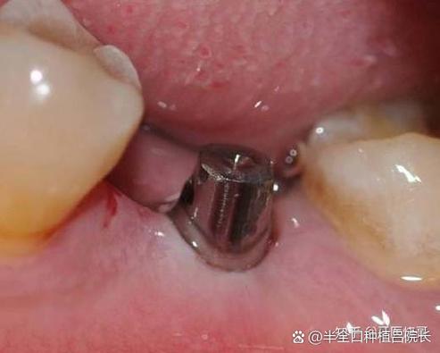 60岁的人有必要种植牙吗截图