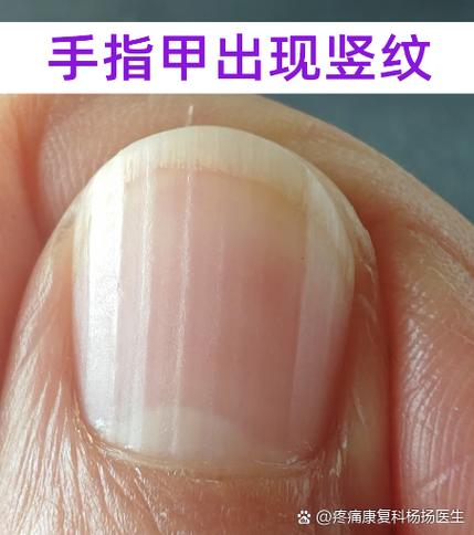 大母指竖纹代表什么
