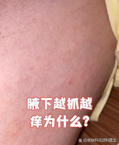 小药挠胳膊窝痒