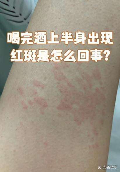 臀部两侧对称红斑要警惕