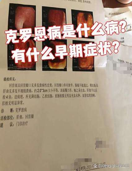 哪些人容易得克罗恩病