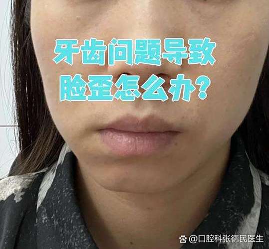 下牙齿缺失导致的脸歪