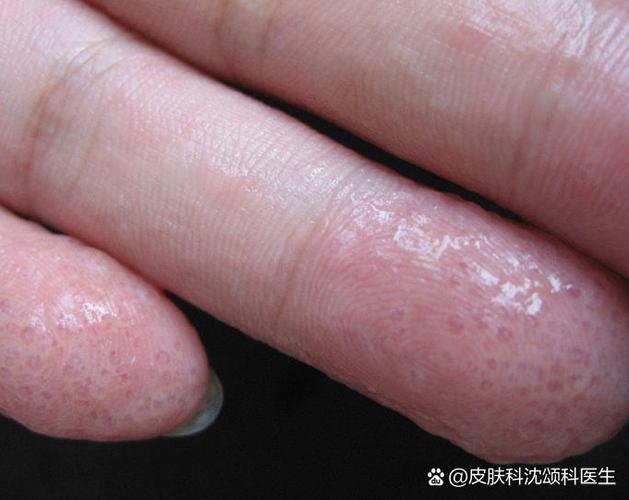汗疱疹图片和症状图片怎么治疗