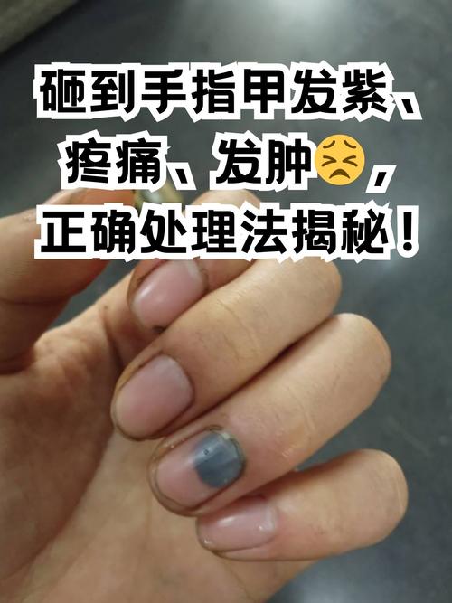 指甲砸伤后的处理方法截图