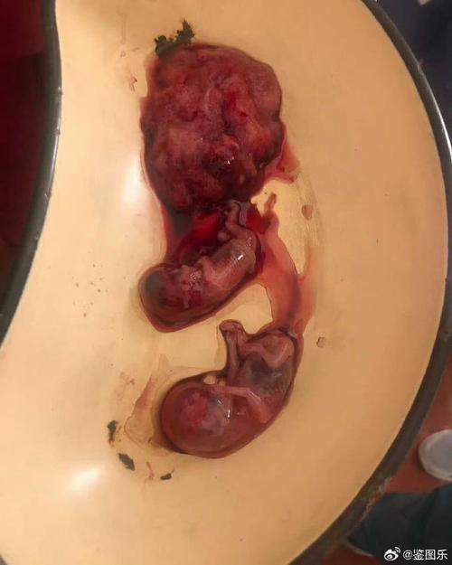 妊娠2恶胎隔绝最新版本更新内容下载