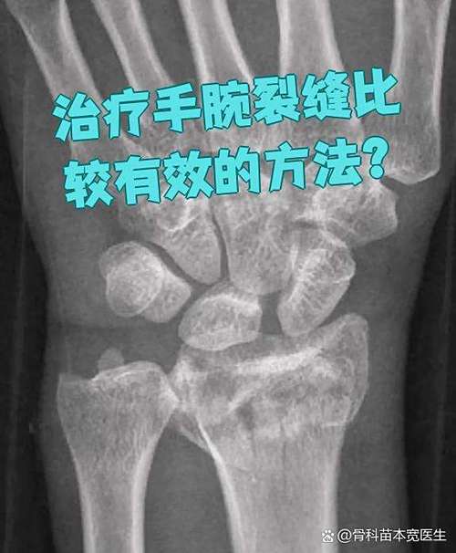 手腕裂缝怎么保养