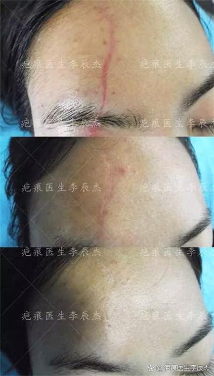 脸部缝针后怎么不留疤