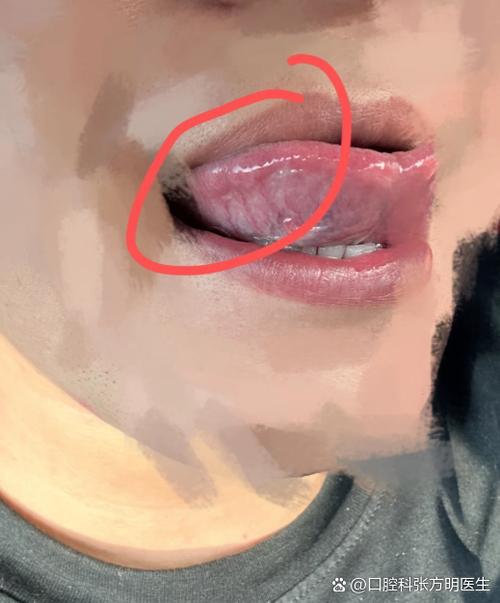 女性舌头轻微麻要警惕