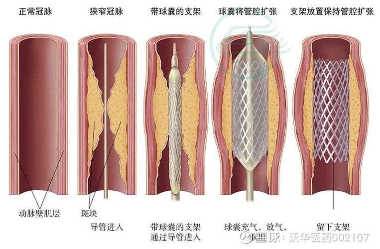 心脏支架一次最多放几个缩略图