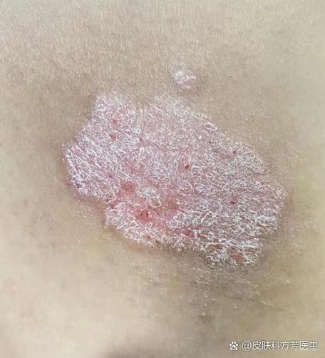 皮肤真菌感染的症状