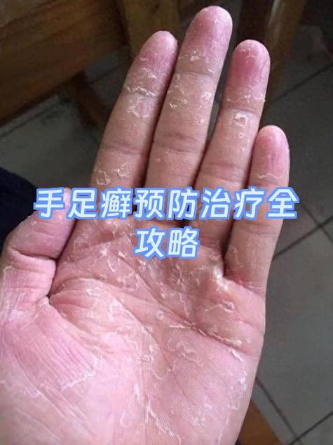 手脚真菌感染怎么根治