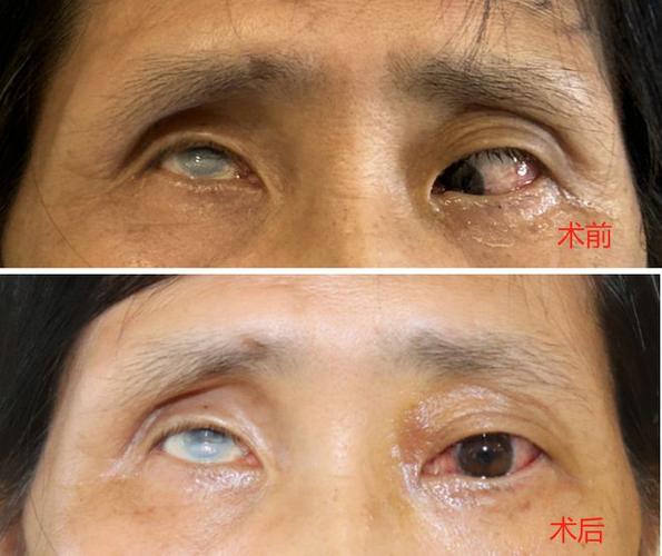 盲人的眼睛可以治好吗