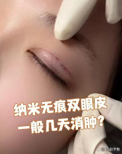 纳米无痕双眼皮恢复期是多久