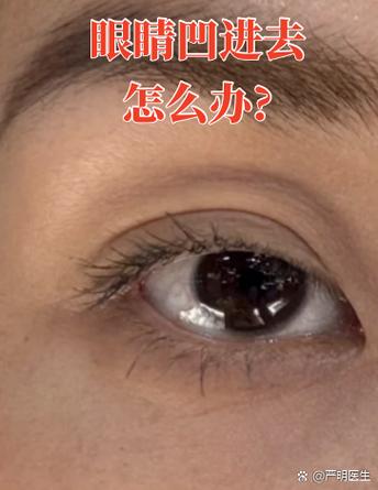 眼睛凹凸是怎么回事