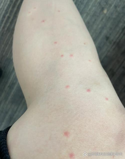 小腿无名起红包硬硬的